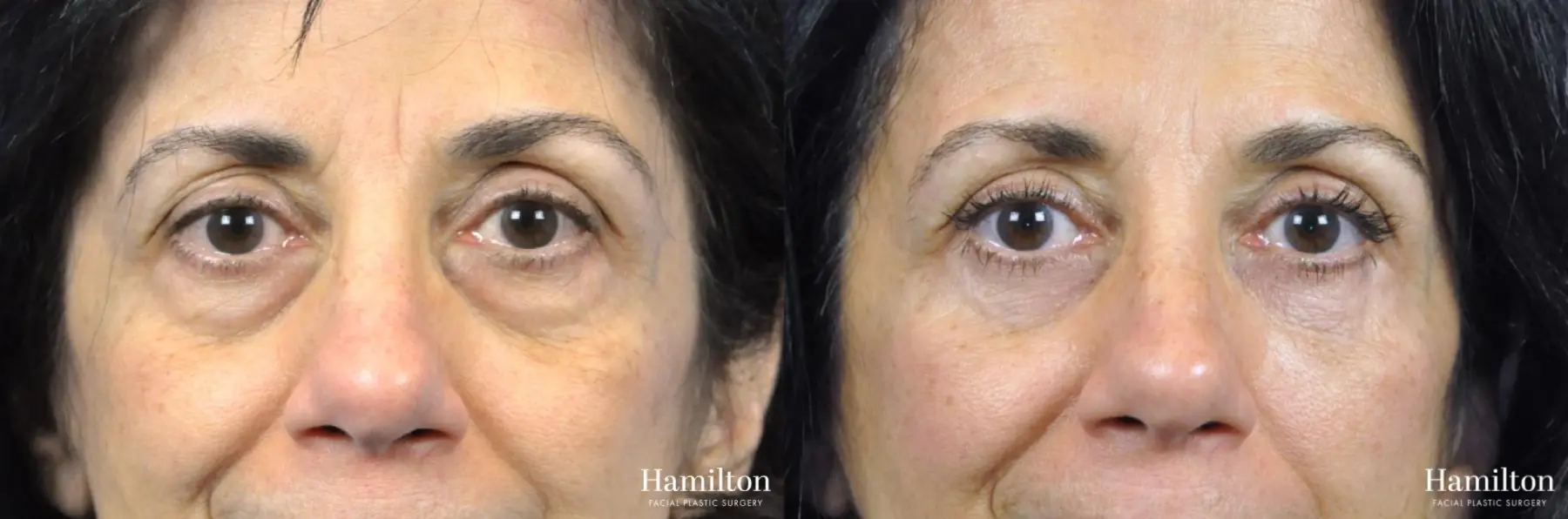 Blepharoplasty: Patient 19 - Before and After 3