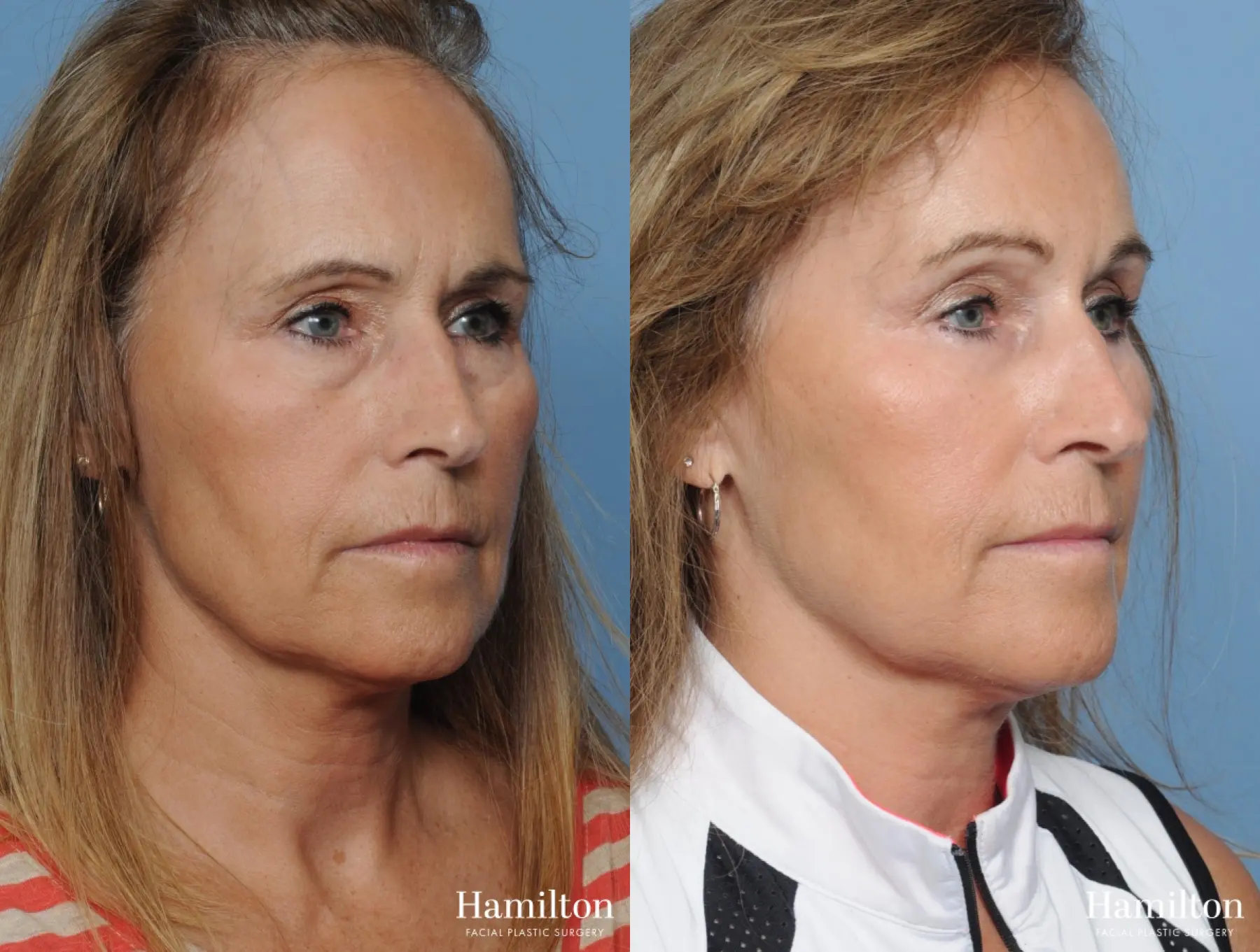 Blepharoplasty: Patient 7 - Before and After 6
