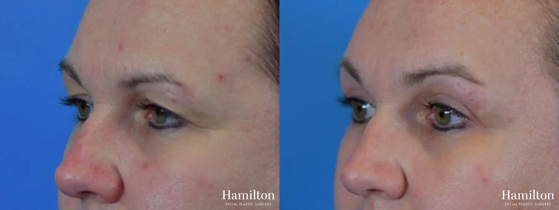 Blepharoplasty: Patient 16 - Before and After 2