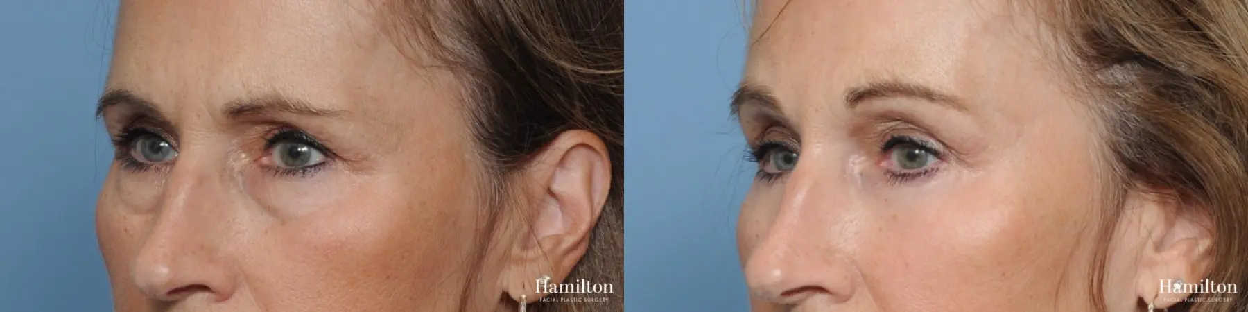 Blepharoplasty: Patient 33 - Before and After 2