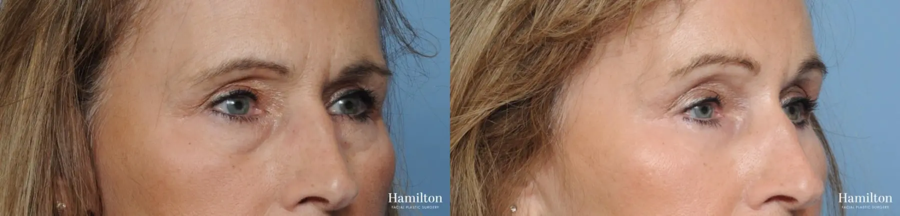 Blepharoplasty: Patient 33 - Before and After 3