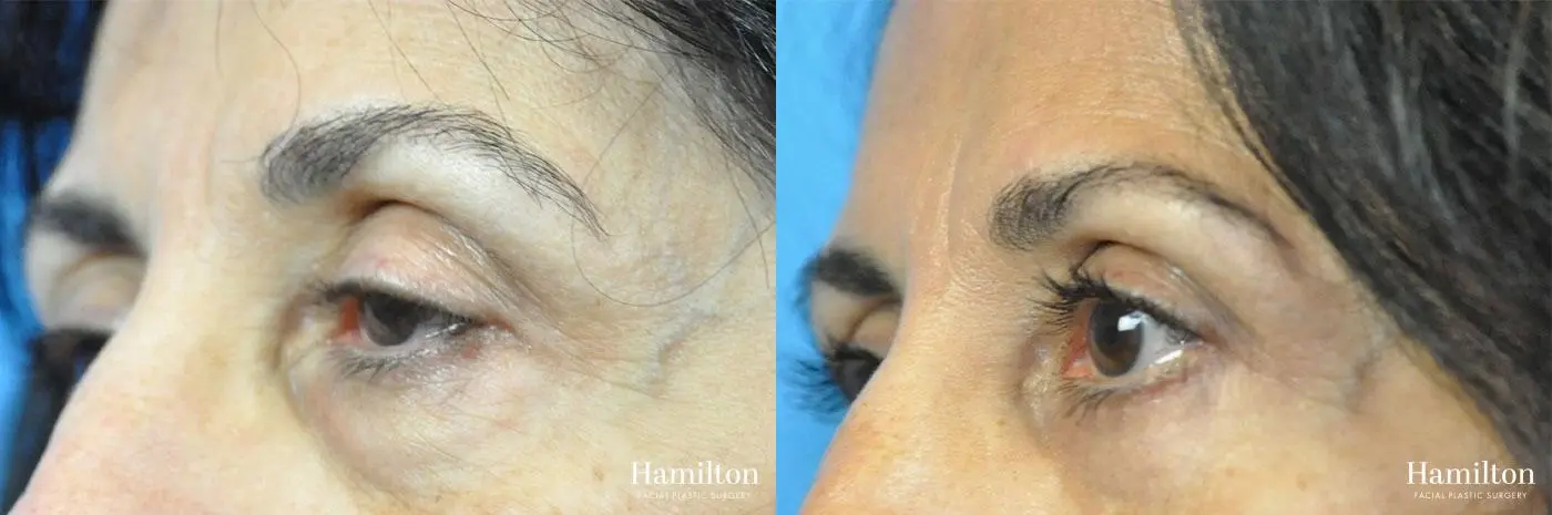 Blepharoplasty: Patient 10 - Before and After 2