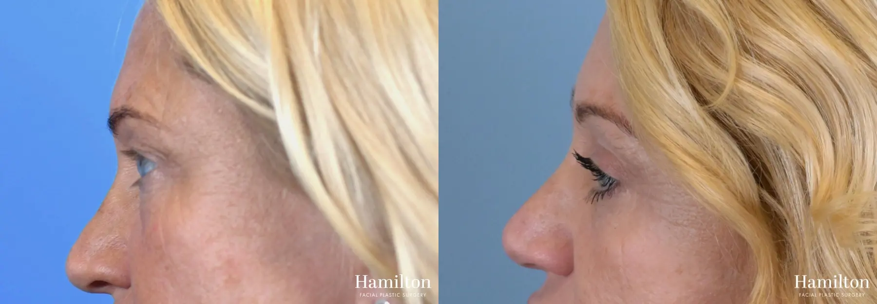 Blepharoplasty: Patient 23 - Before and After 2
