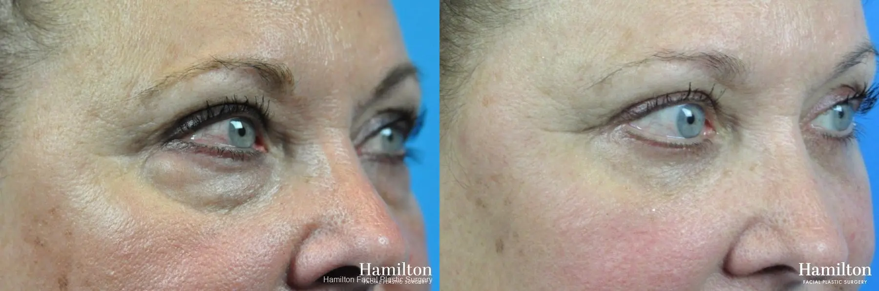 Blepharoplasty: Patient 9 - Before and After 3