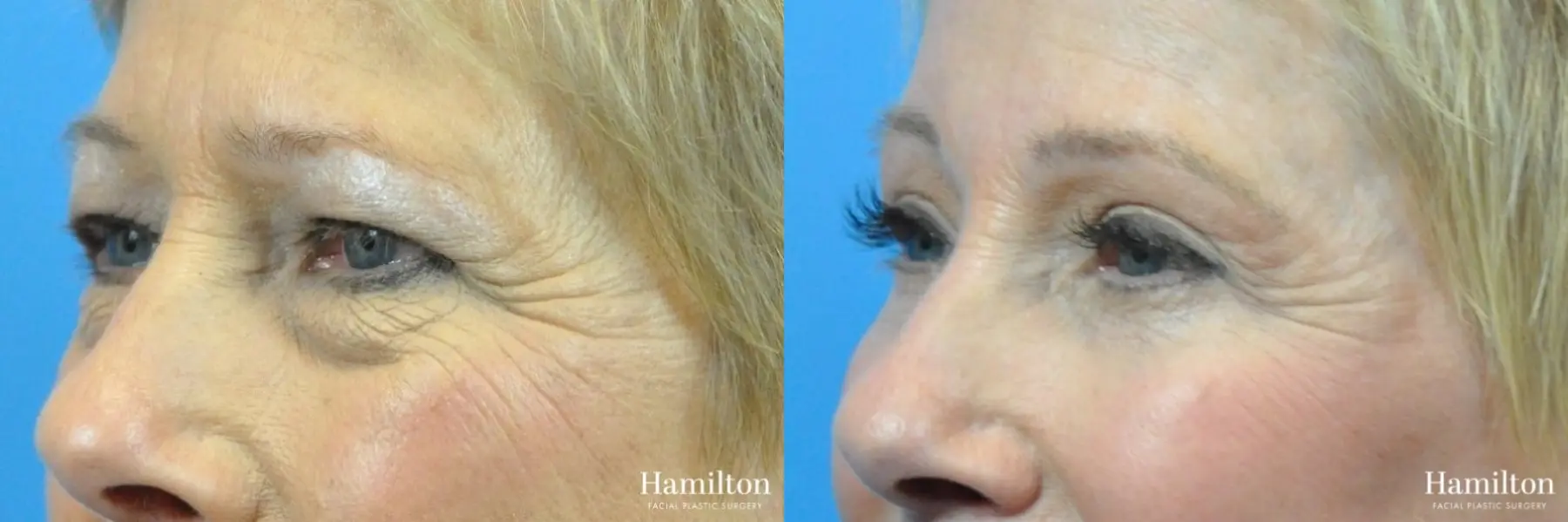 Blepharoplasty: Patient 2 - Before and After 2