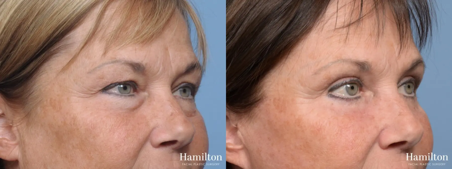 Blepharoplasty: Patient 12 - Before and After 3