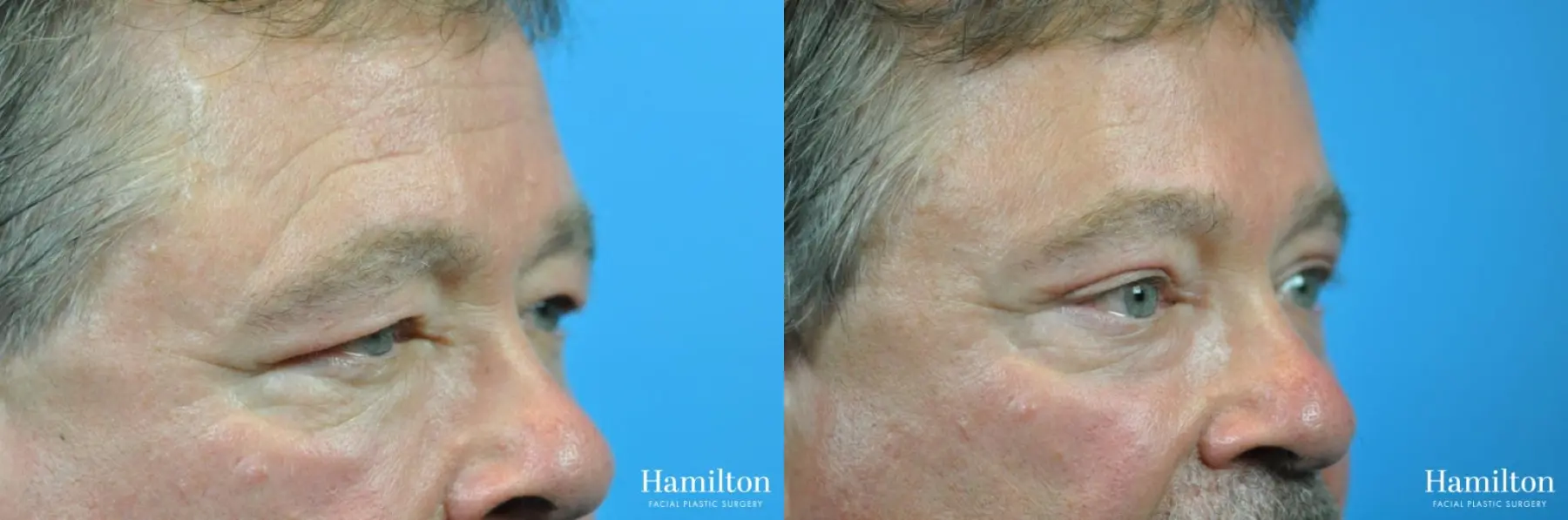Blepharoplasty: Patient 17 - Before and After 4