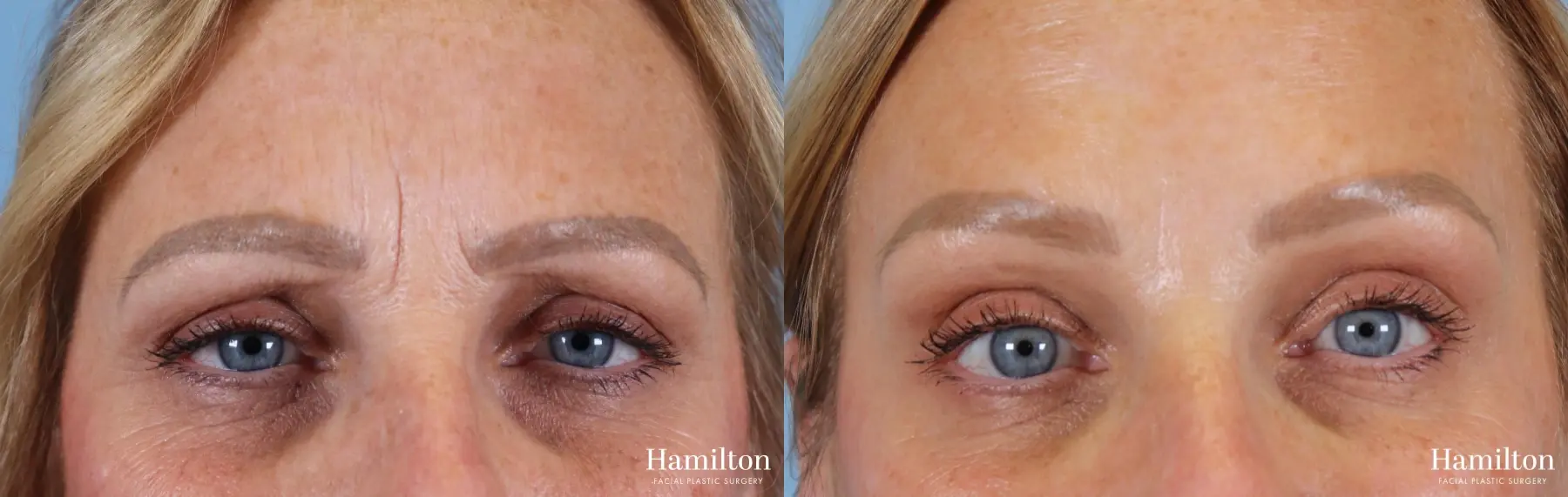 BOTOX® Cosmetic: Patient 3 - Before and After 1