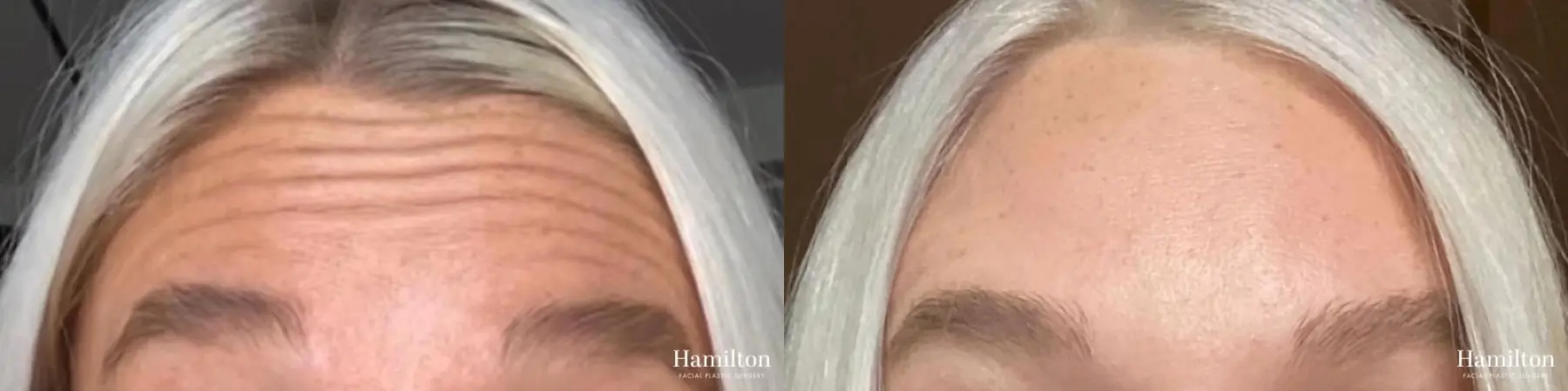 BOTOX® Cosmetic: Patient 1 - Before and After 1