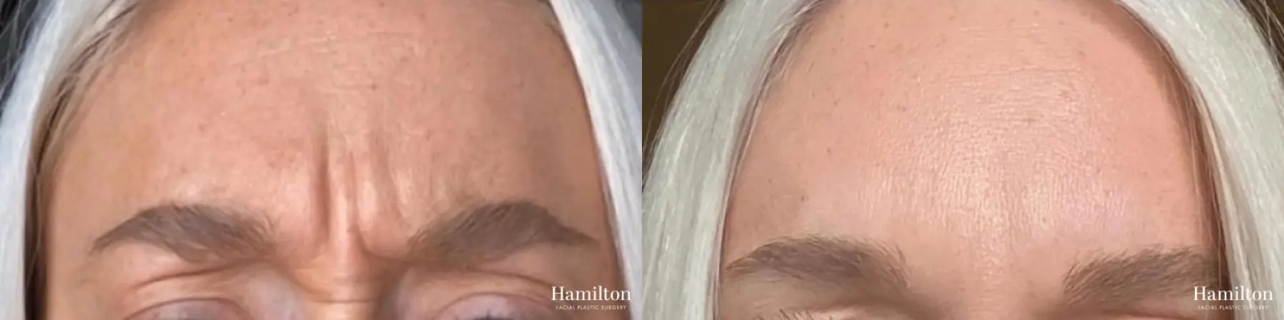 BOTOX® Cosmetic: Patient 1 - Before and After 2