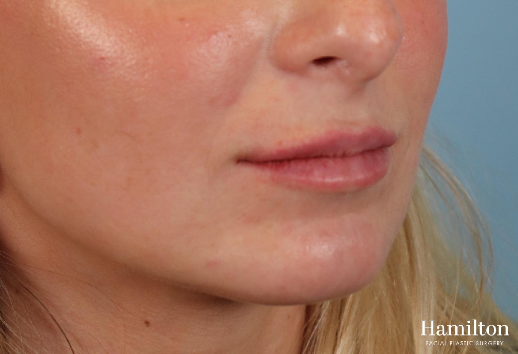 Lip Enhancement: Patient 7 - After  
