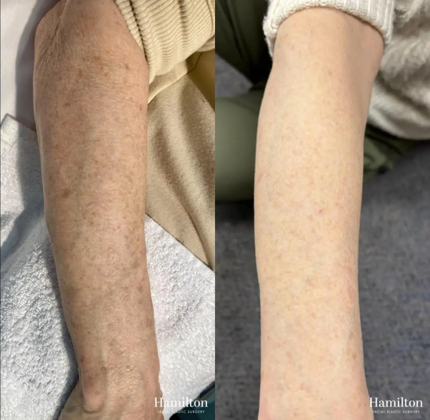 Broad Band Light (BBL): Patient 2 - Before and After  