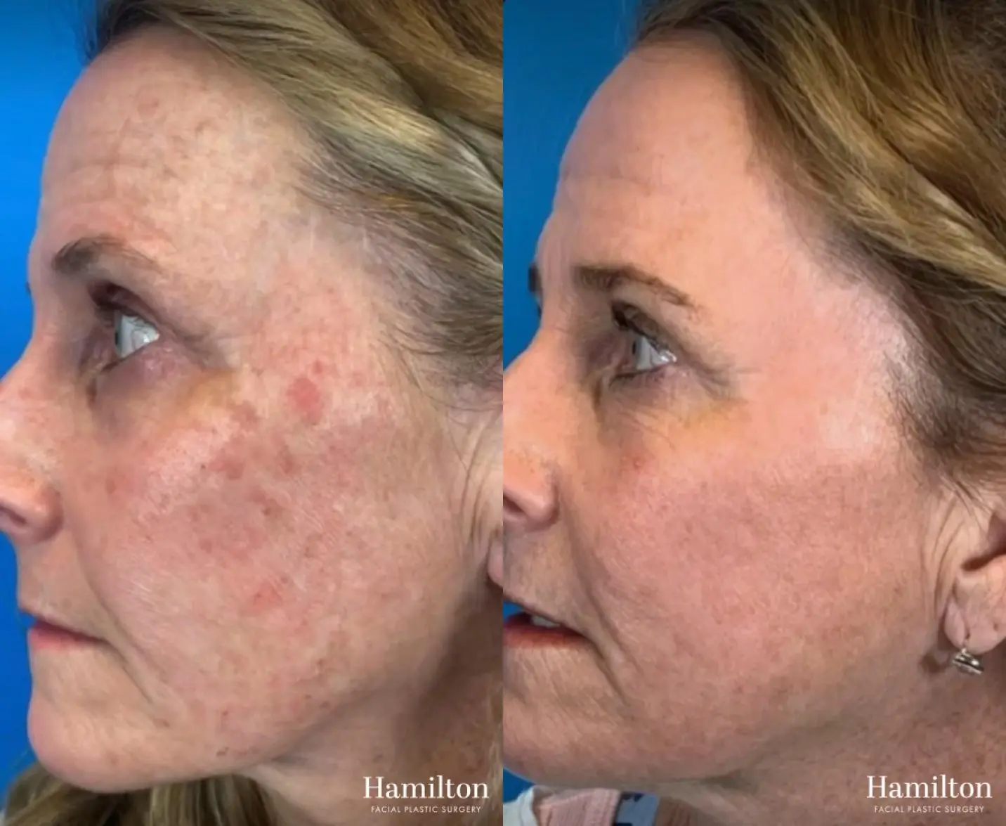 Broad Band Light (BBL): Patient 5 - Before and After  
