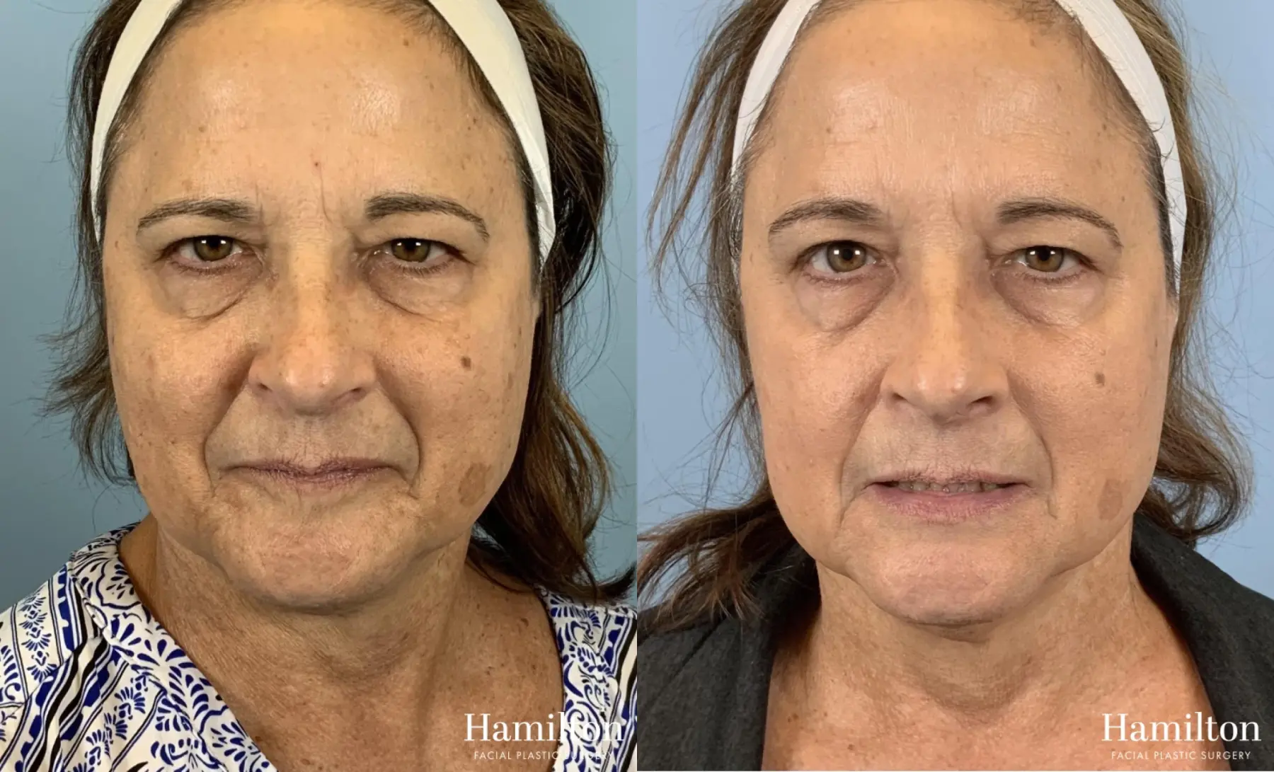 Broad Band Light (BBL): Patient 12 - Before and After 3