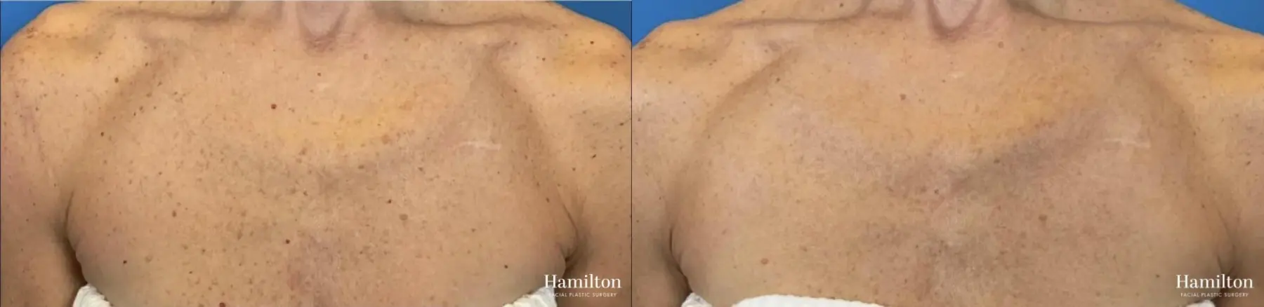 Broad Band Light (BBL): Patient 8 - Before and After  