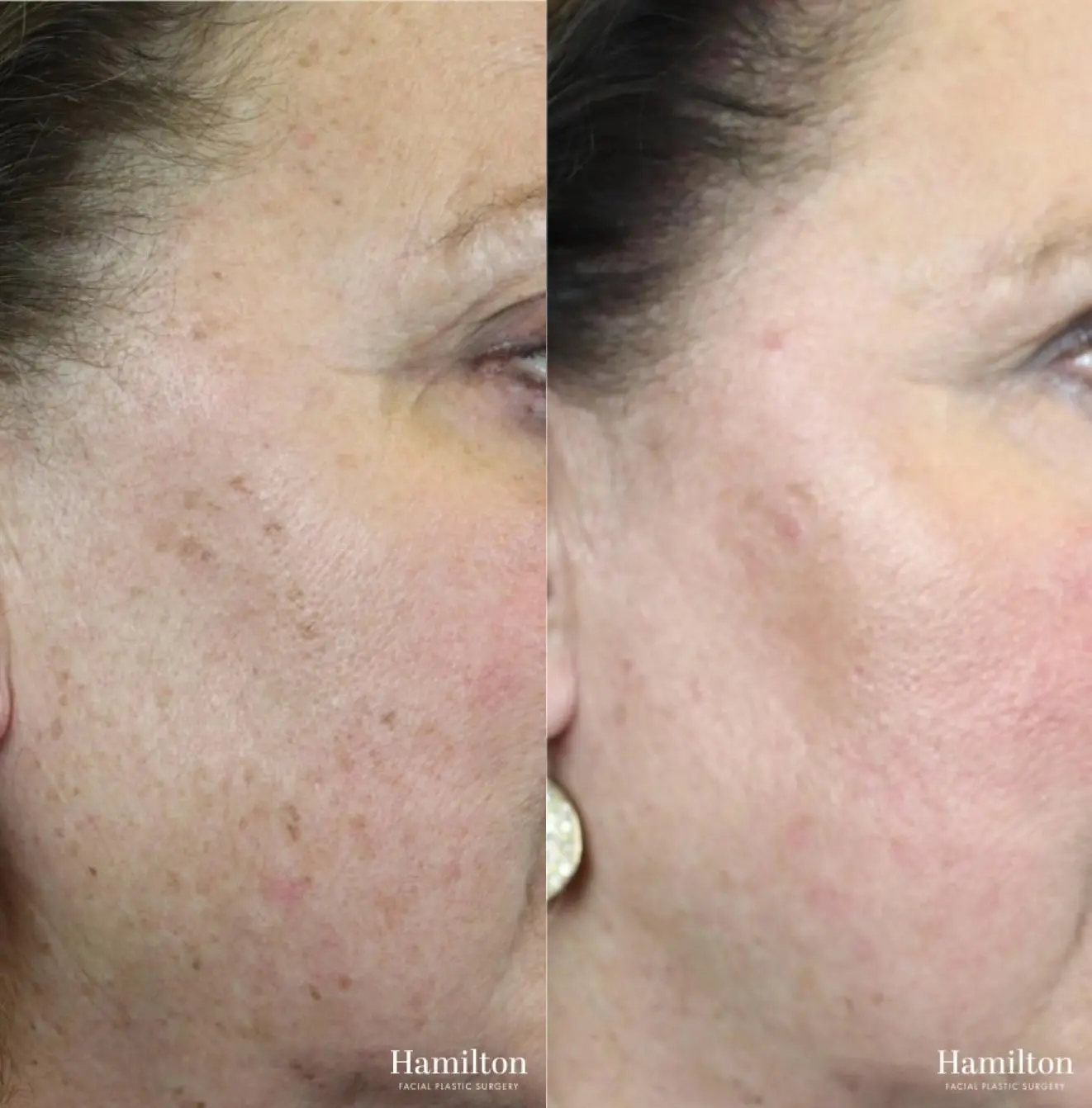 Broad Band Light (BBL): Patient 13 - Before and After 1