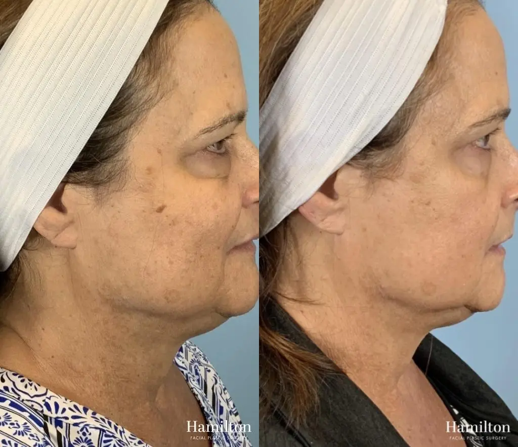 Broad Band Light (BBL): Patient 12 - Before and After 1