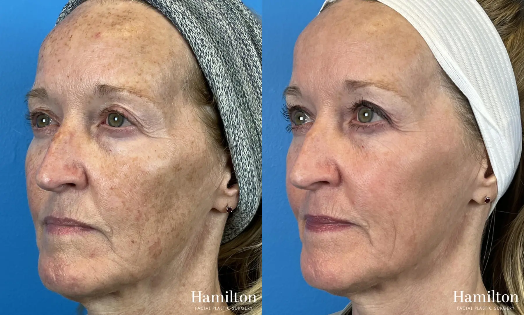 Broad Band Light (BBL): Patient 1 - Before and After 2