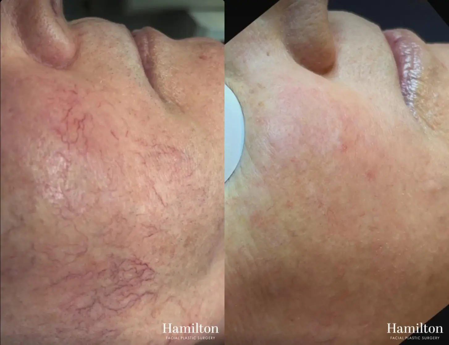 Broad Band Light (BBL): Patient 6 - Before and After  