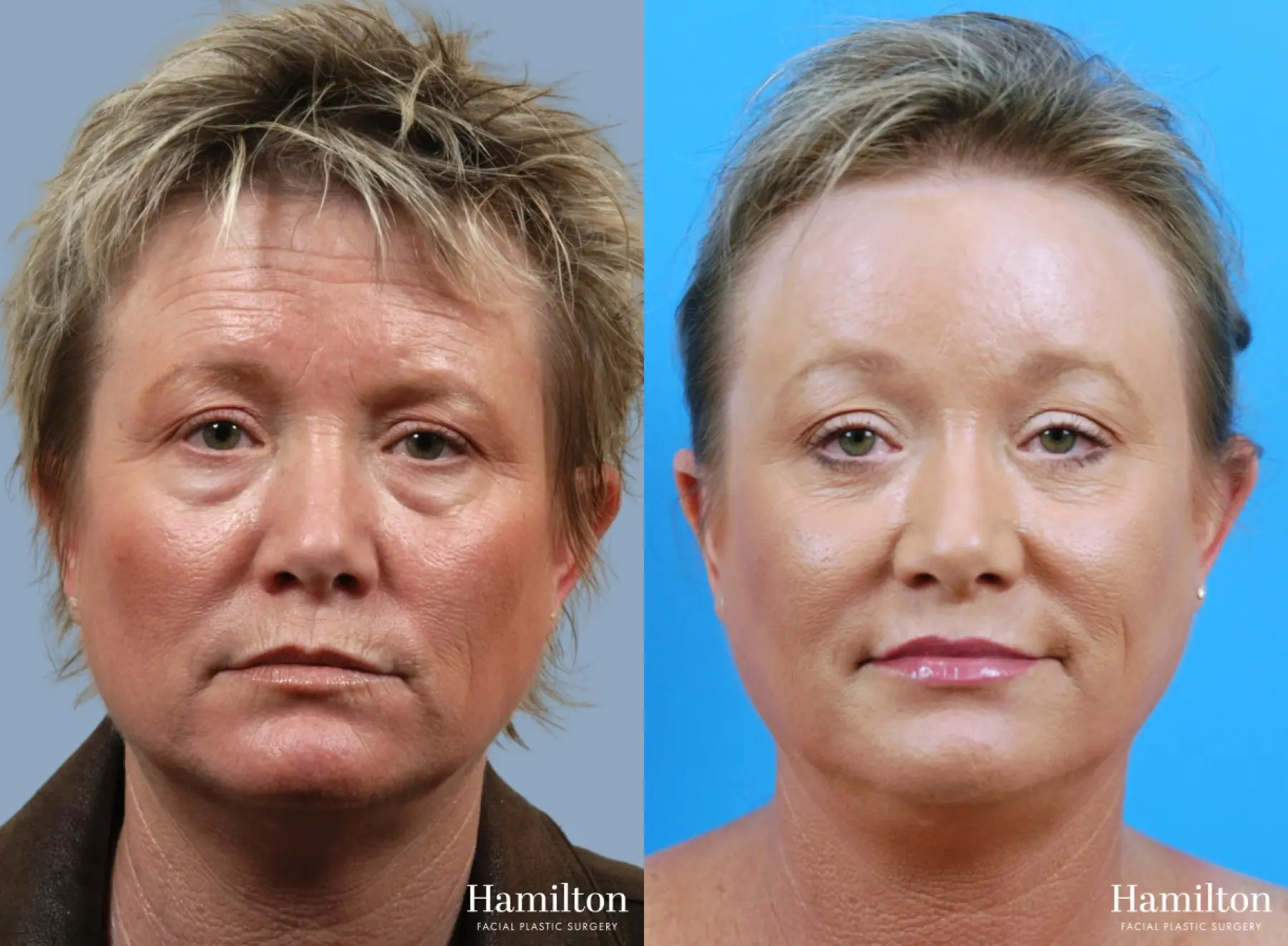 Brow Lift: Patient 12 - Before and After 1