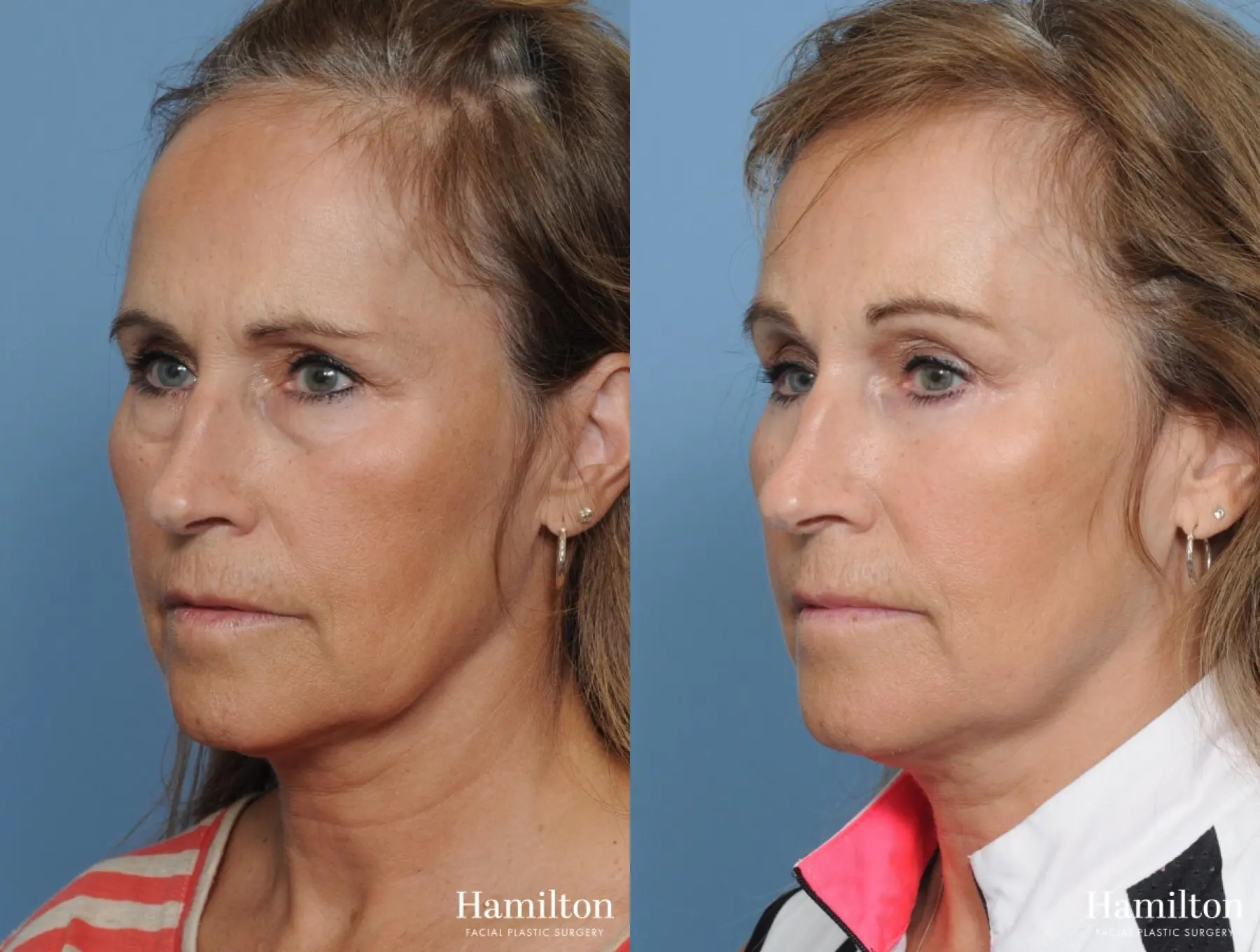 Brow Lift: Patient 9 - Before and After 2