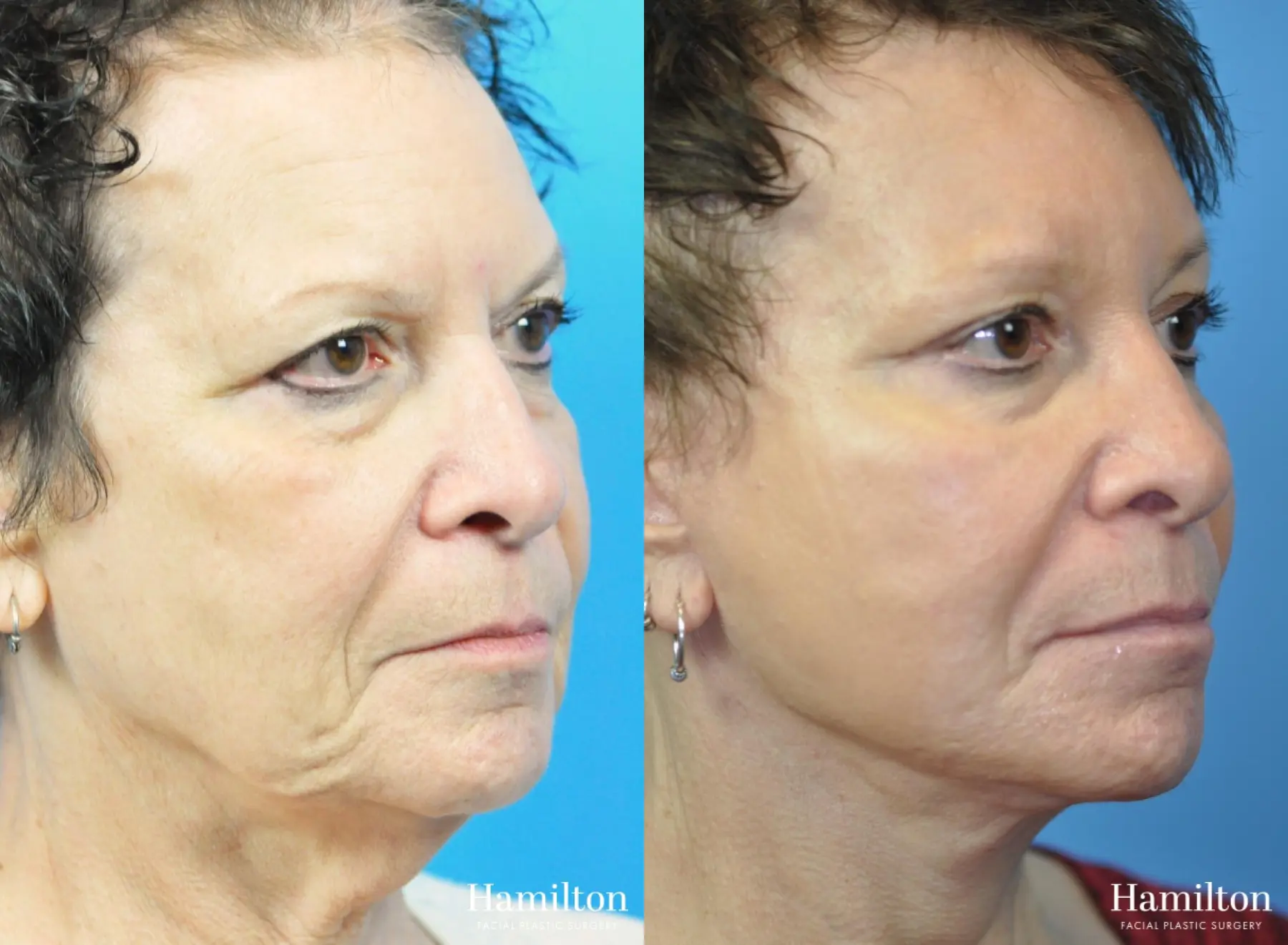 Brow Lift: Patient 11 - Before and After 2