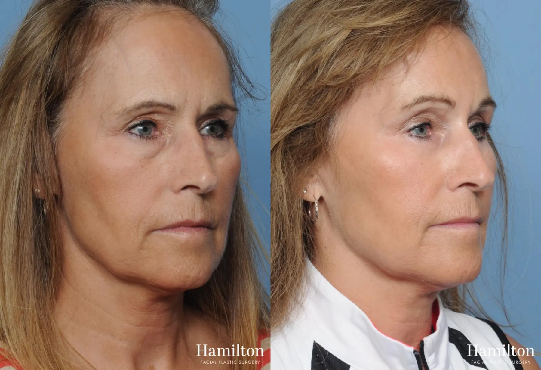 Brow Lift: Patient 10 - Before and After 3