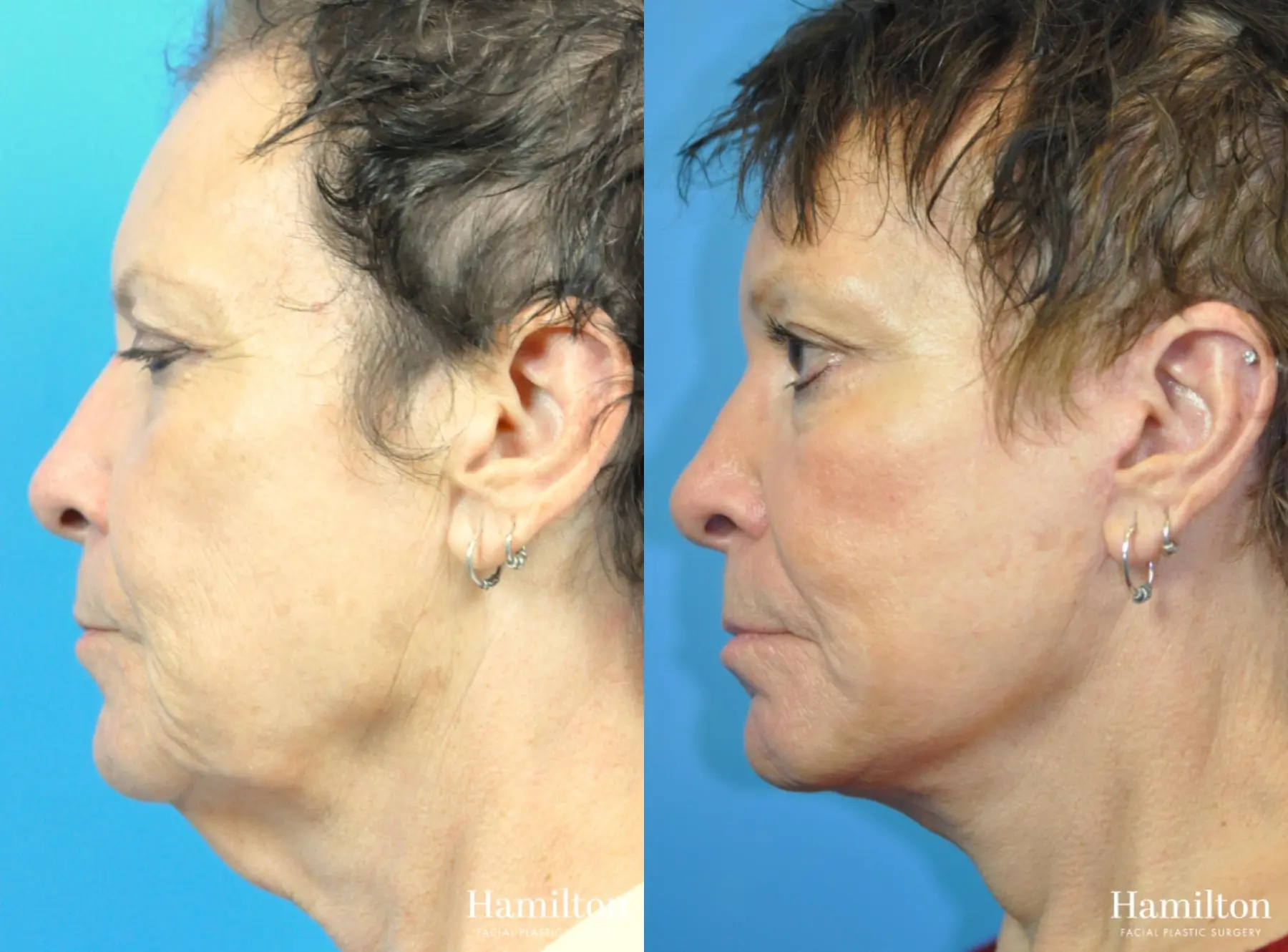 Brow Lift: Patient 11 - Before and After 3