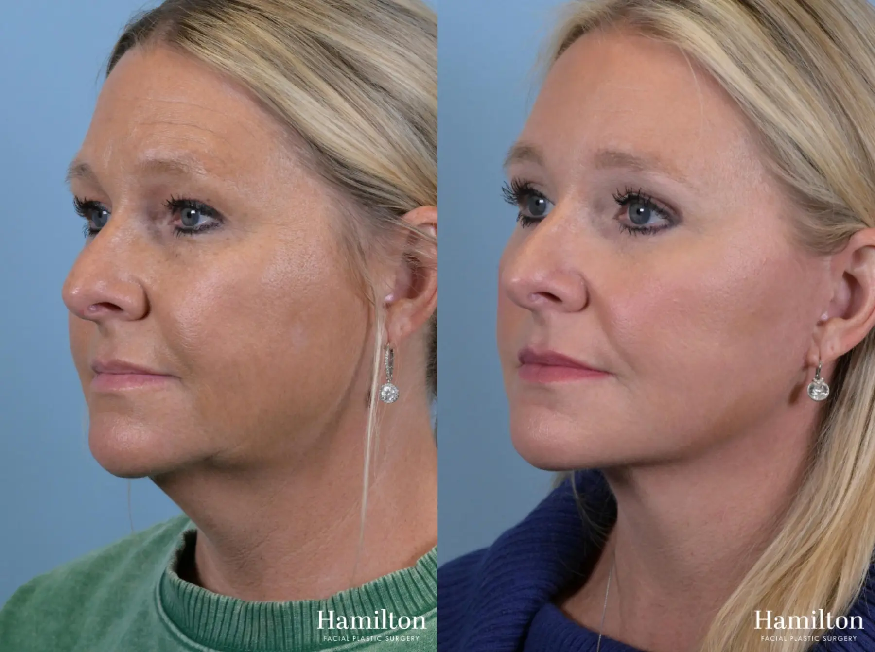 Brow Lift: Patient 6 - Before and After 2