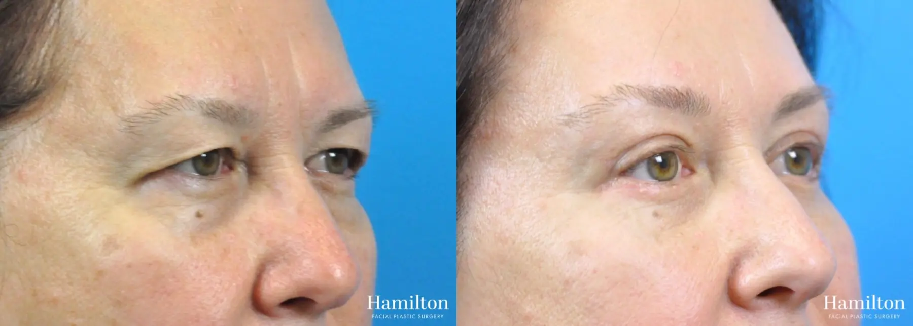 Brow Lift: Patient 9 - Before and After 2