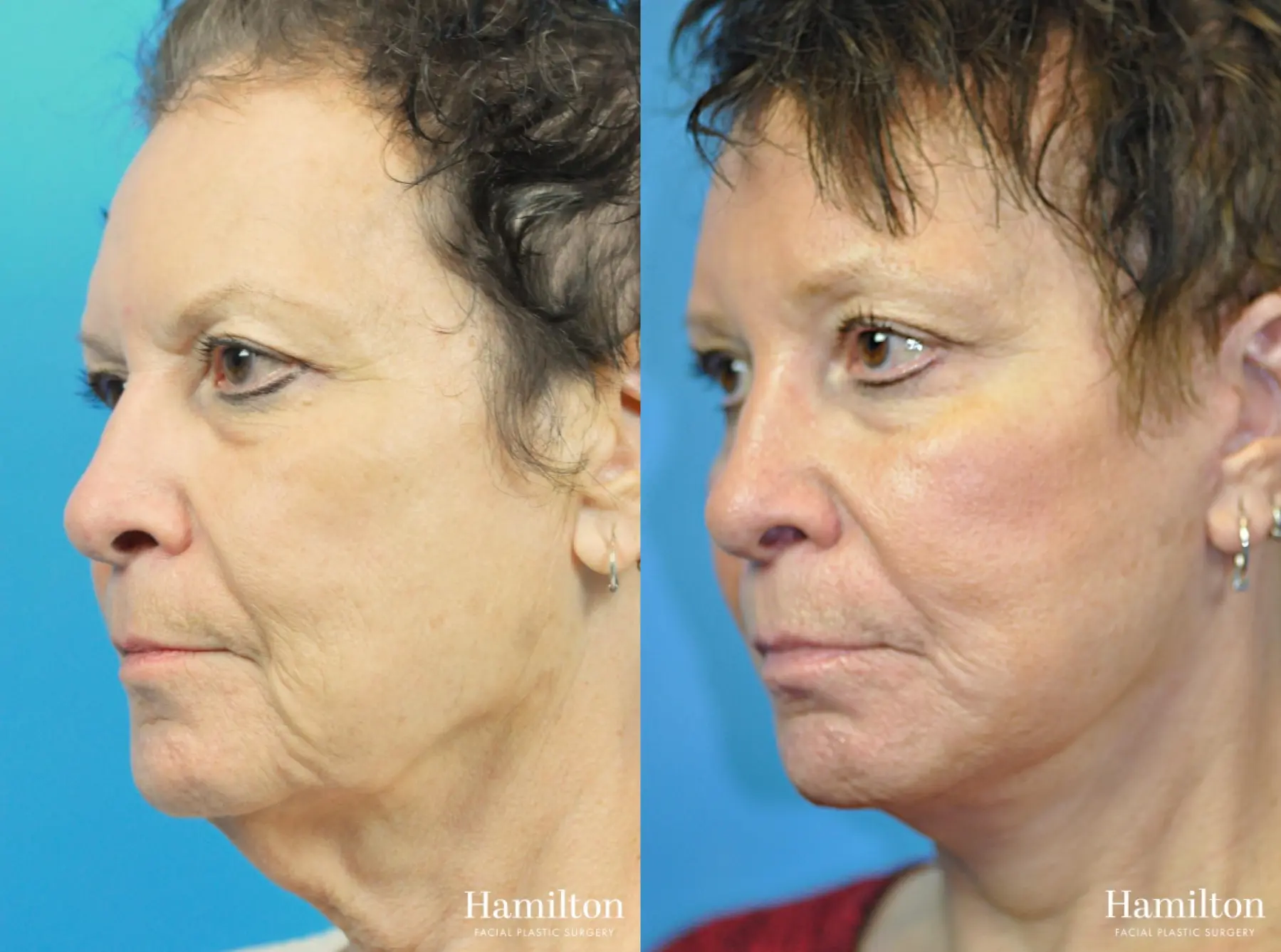 Brow Lift: Patient 11 - Before and After 5