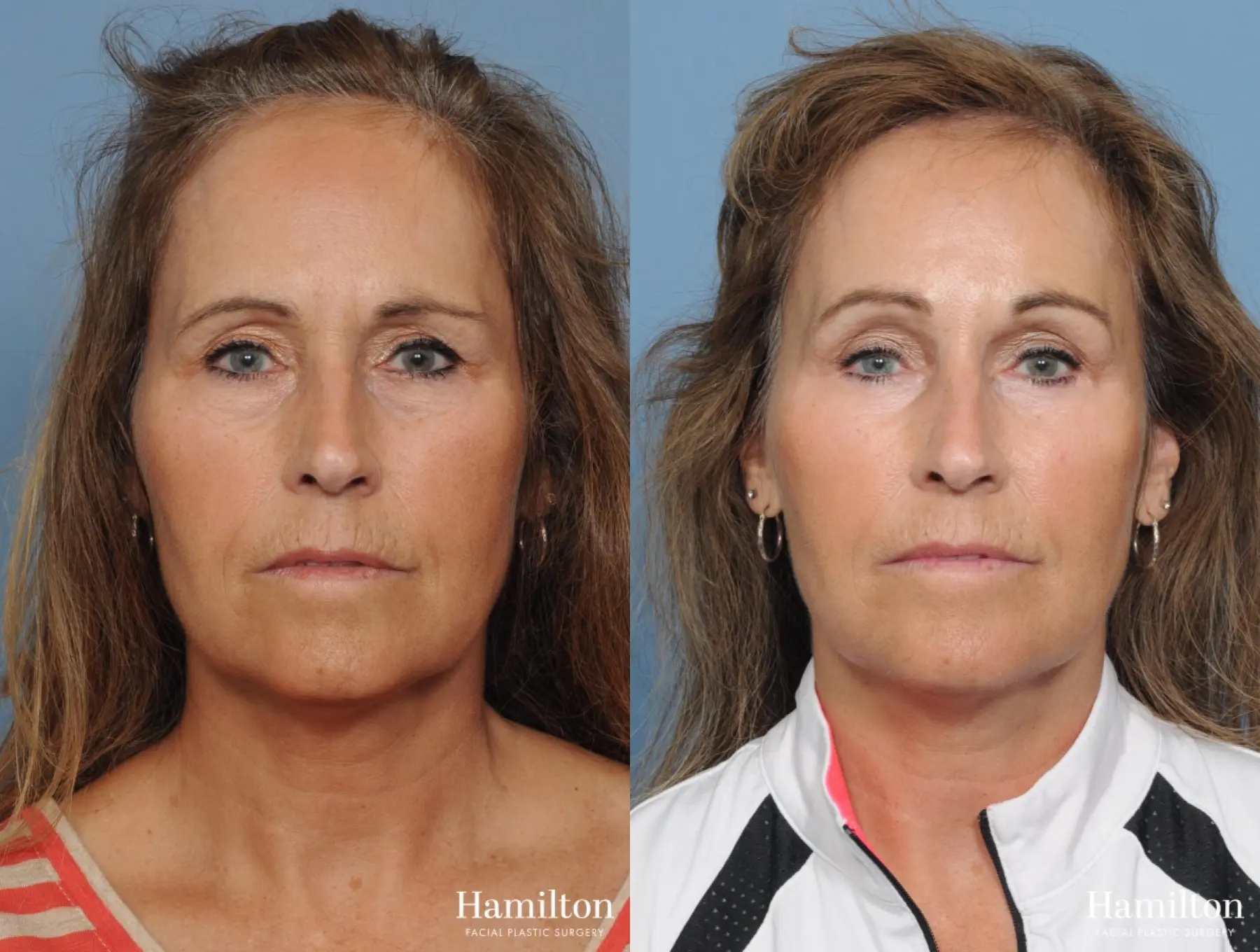 Brow Lift: Patient 10 - Before and After 1