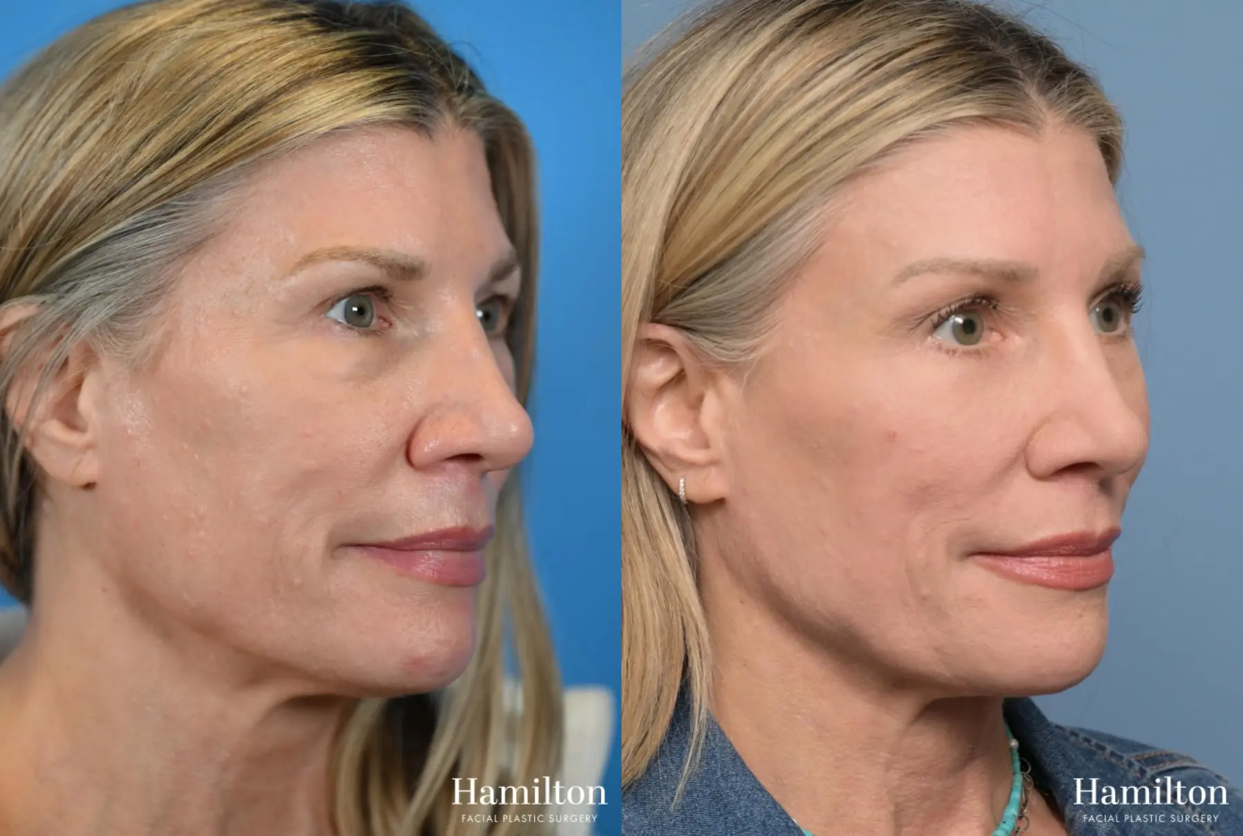 Brow Lift: Patient 6 - Before and After 5