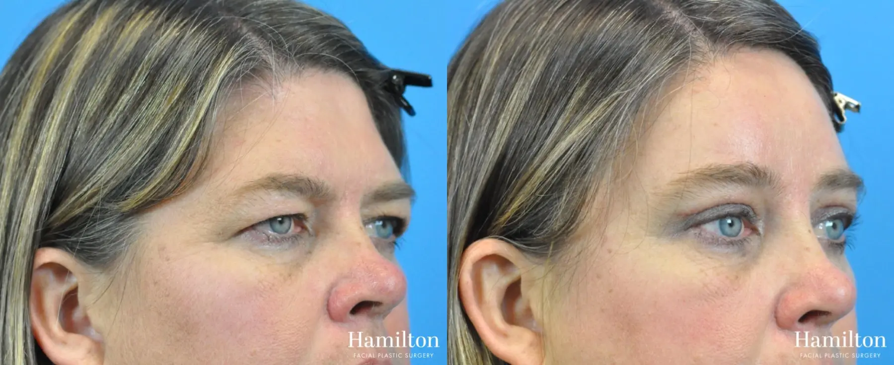 Brow Lift: Patient 8 - Before and After 3