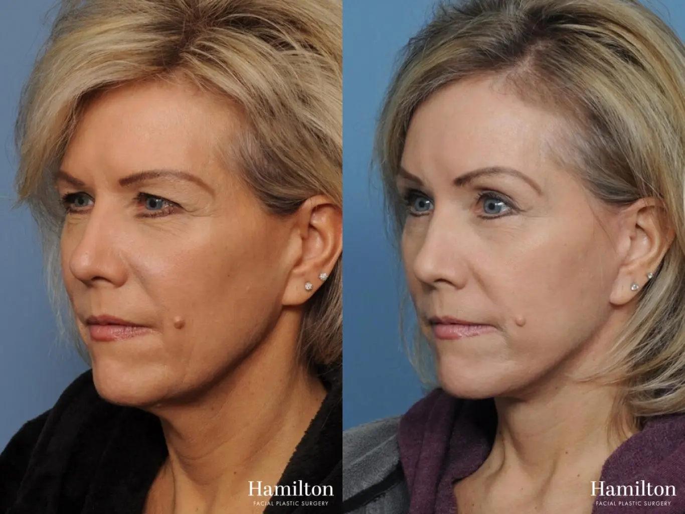 Brow Lift: Patient 3 - Before and After 2