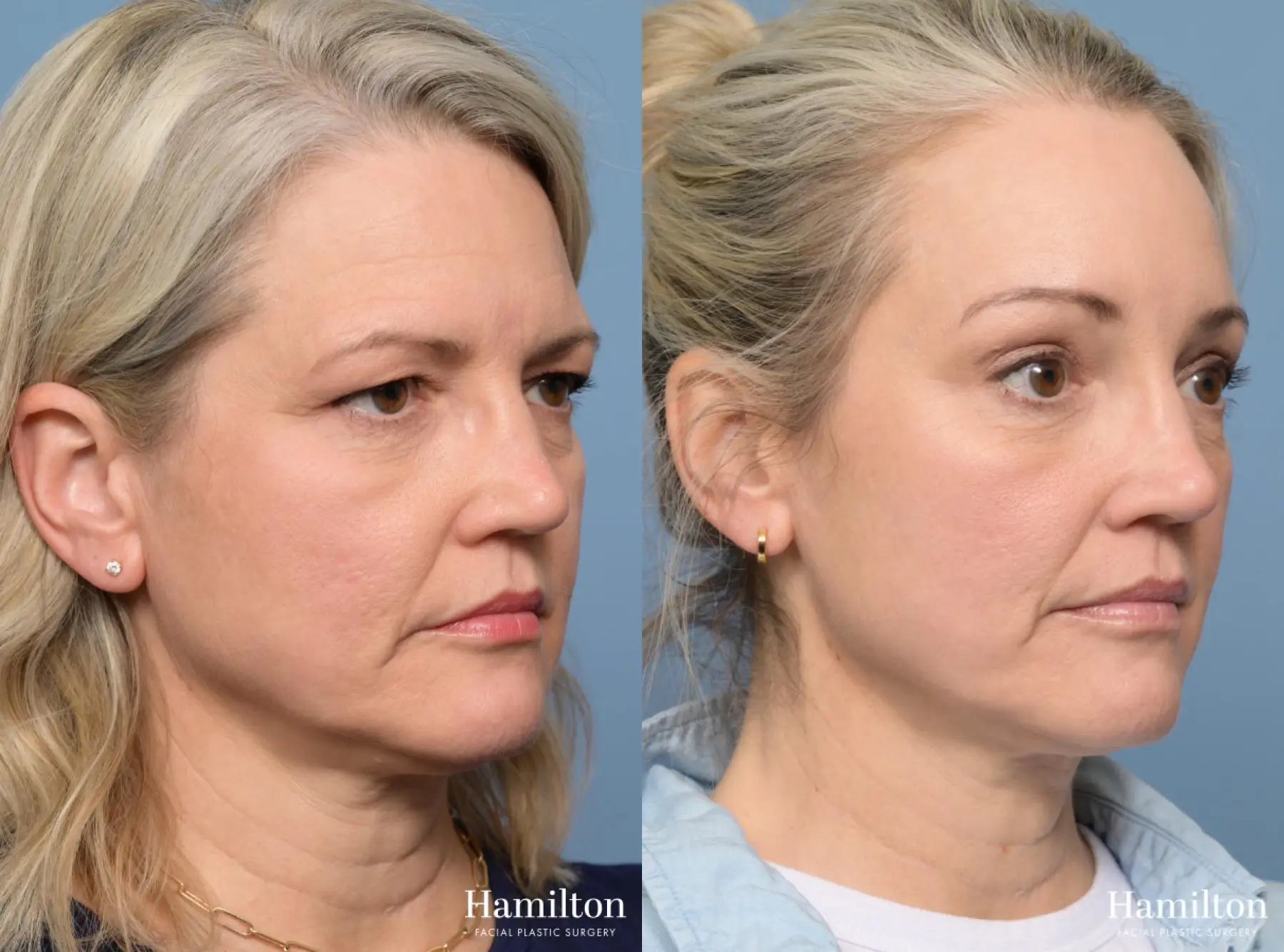 Brow Lift: Patient 3 - Before and After 3