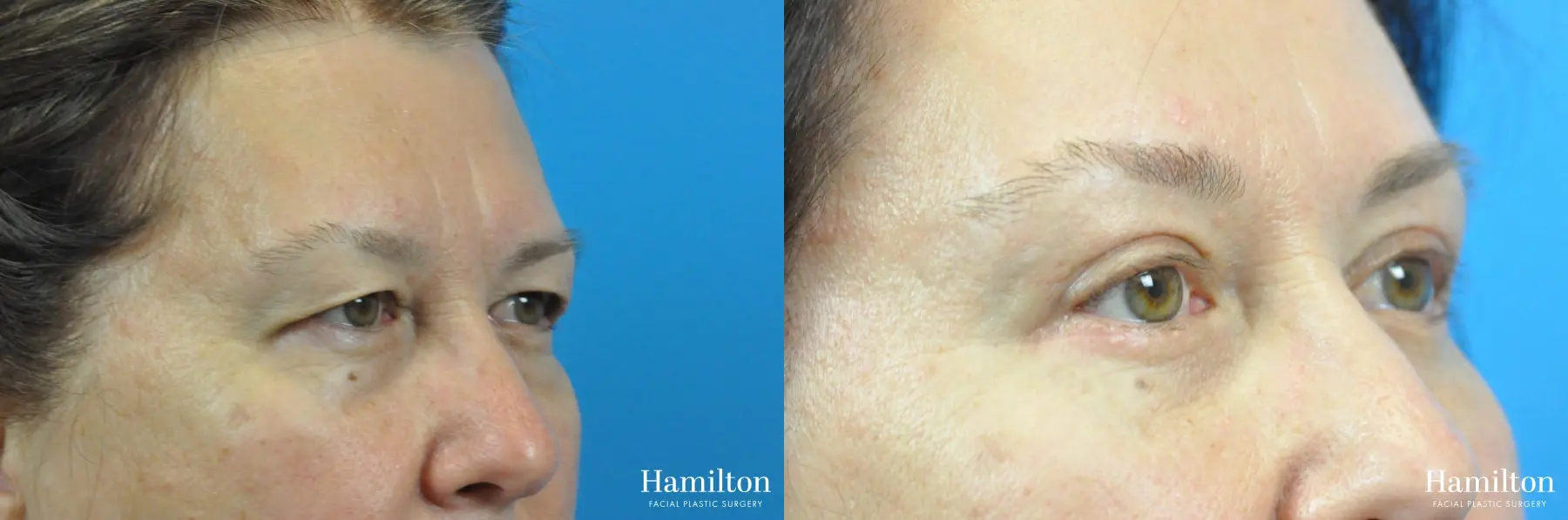 Brow Lift: Patient 6 - Before and After  