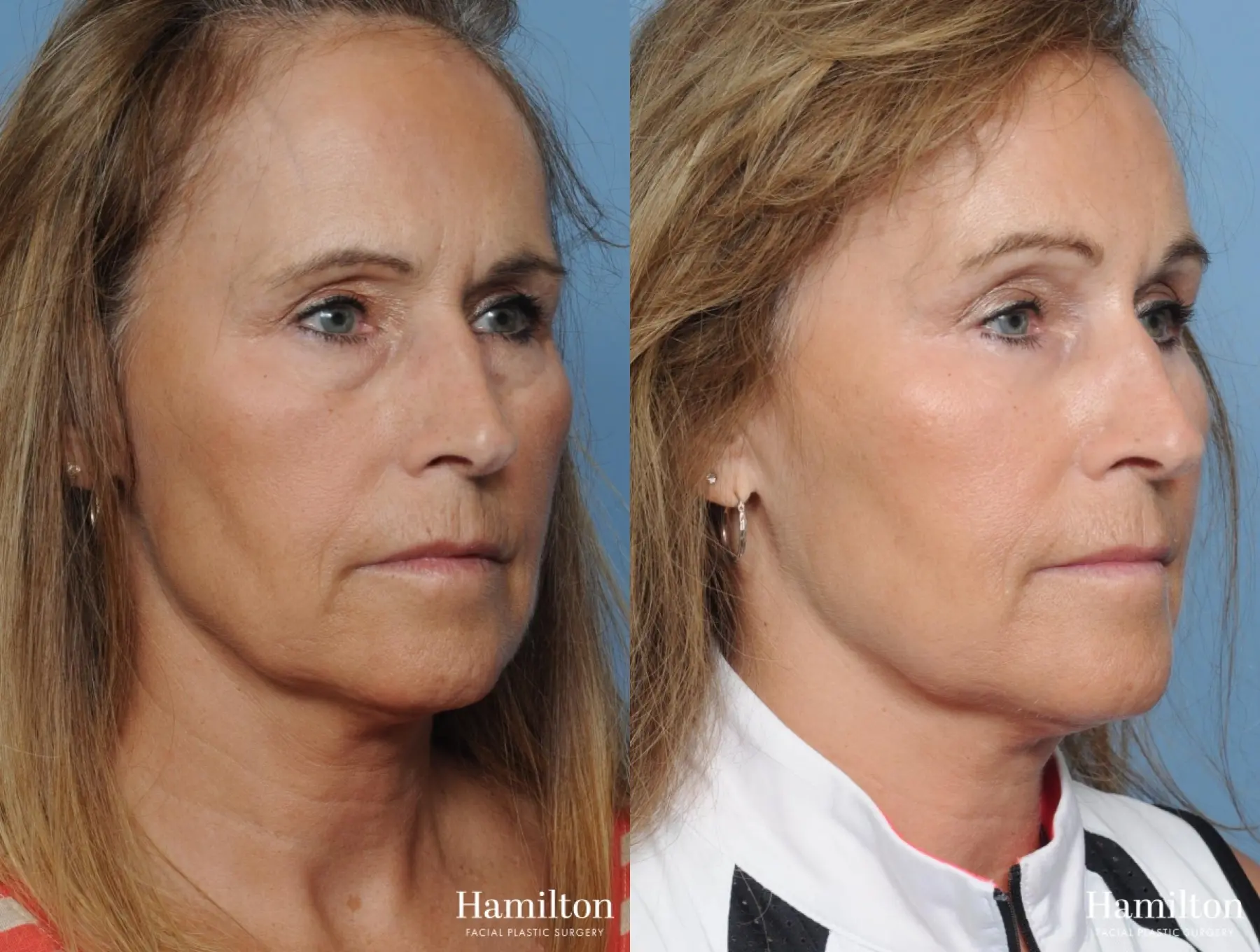 Brow Lift: Patient 9 - Before and After 3