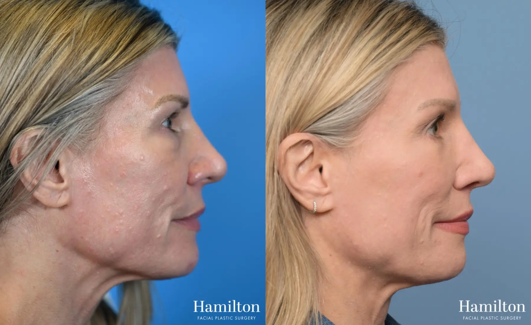 Brow Lift: Patient 6 - Before and After 4