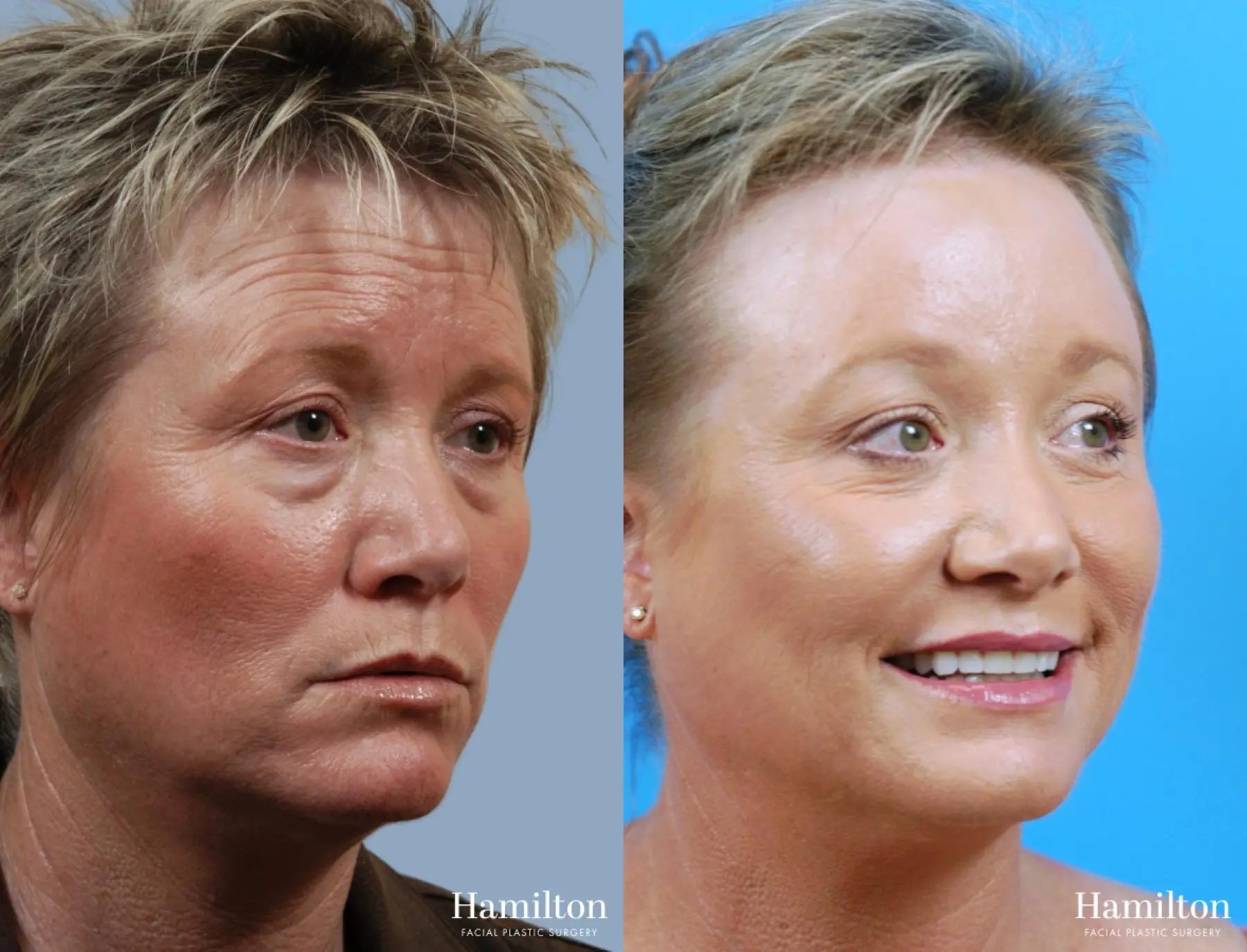 Brow Lift: Patient 12 - Before and After 3