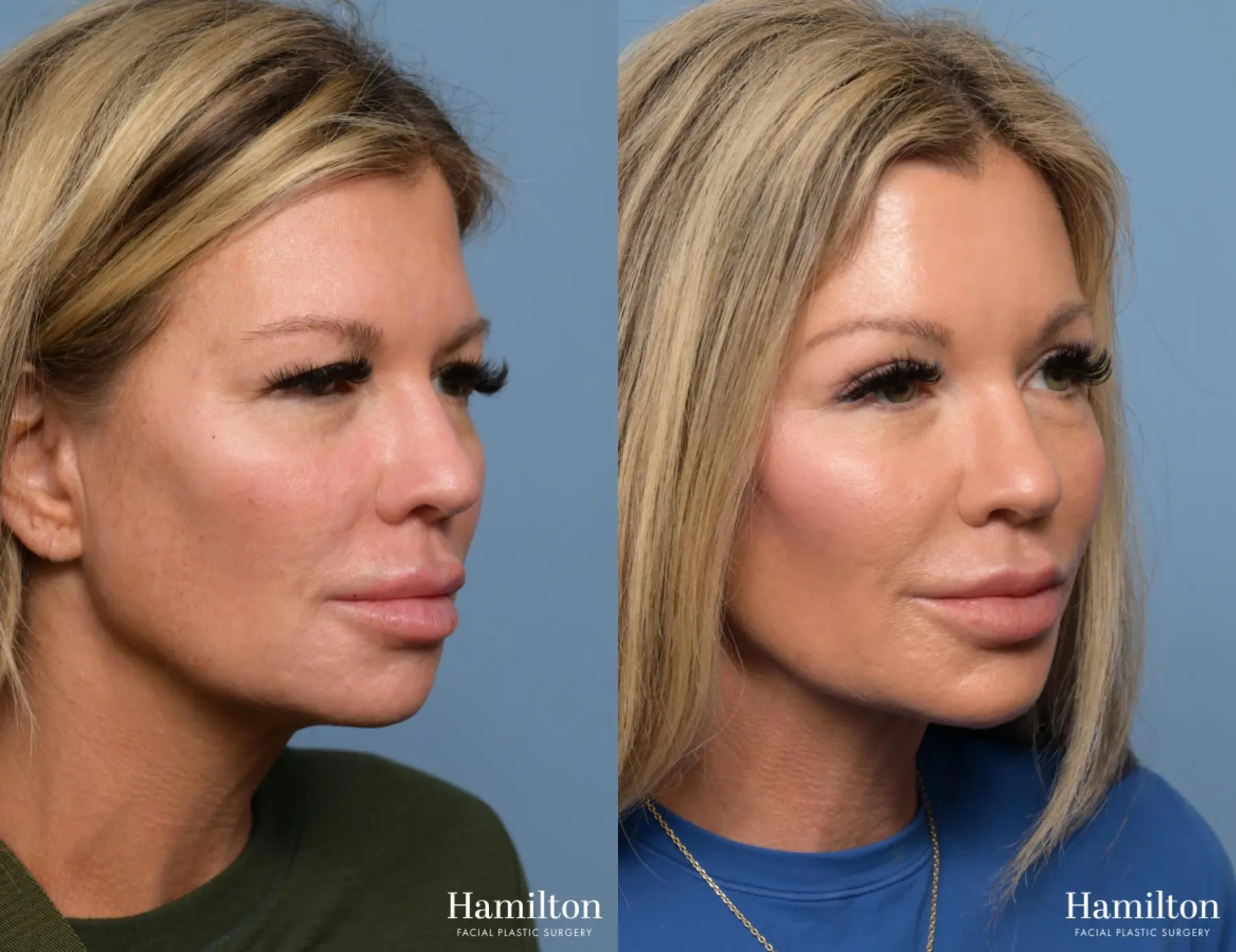 Brow Lift: Patient 2 - Before and After 3