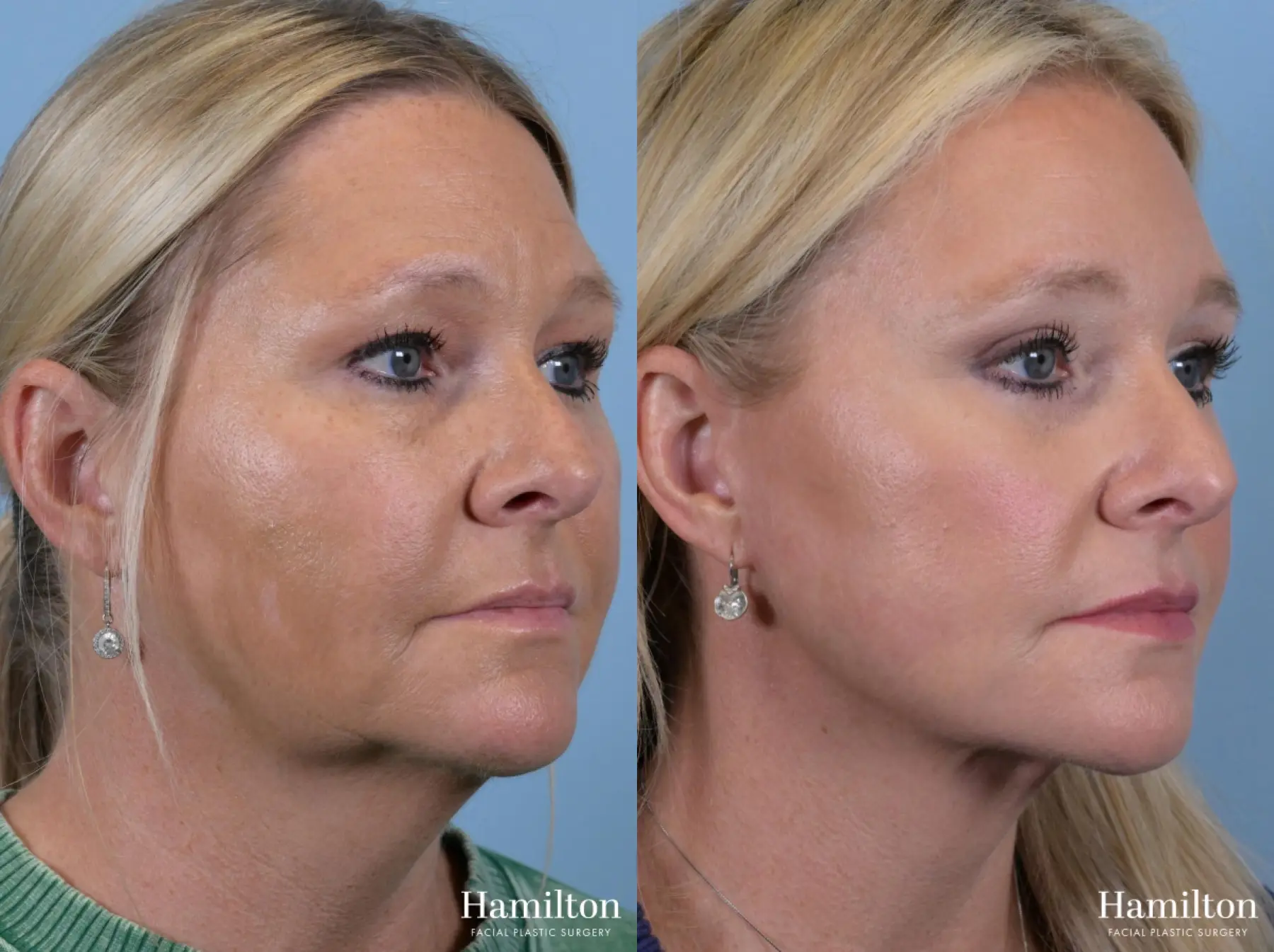 Brow Lift: Patient 6 - Before and After 5