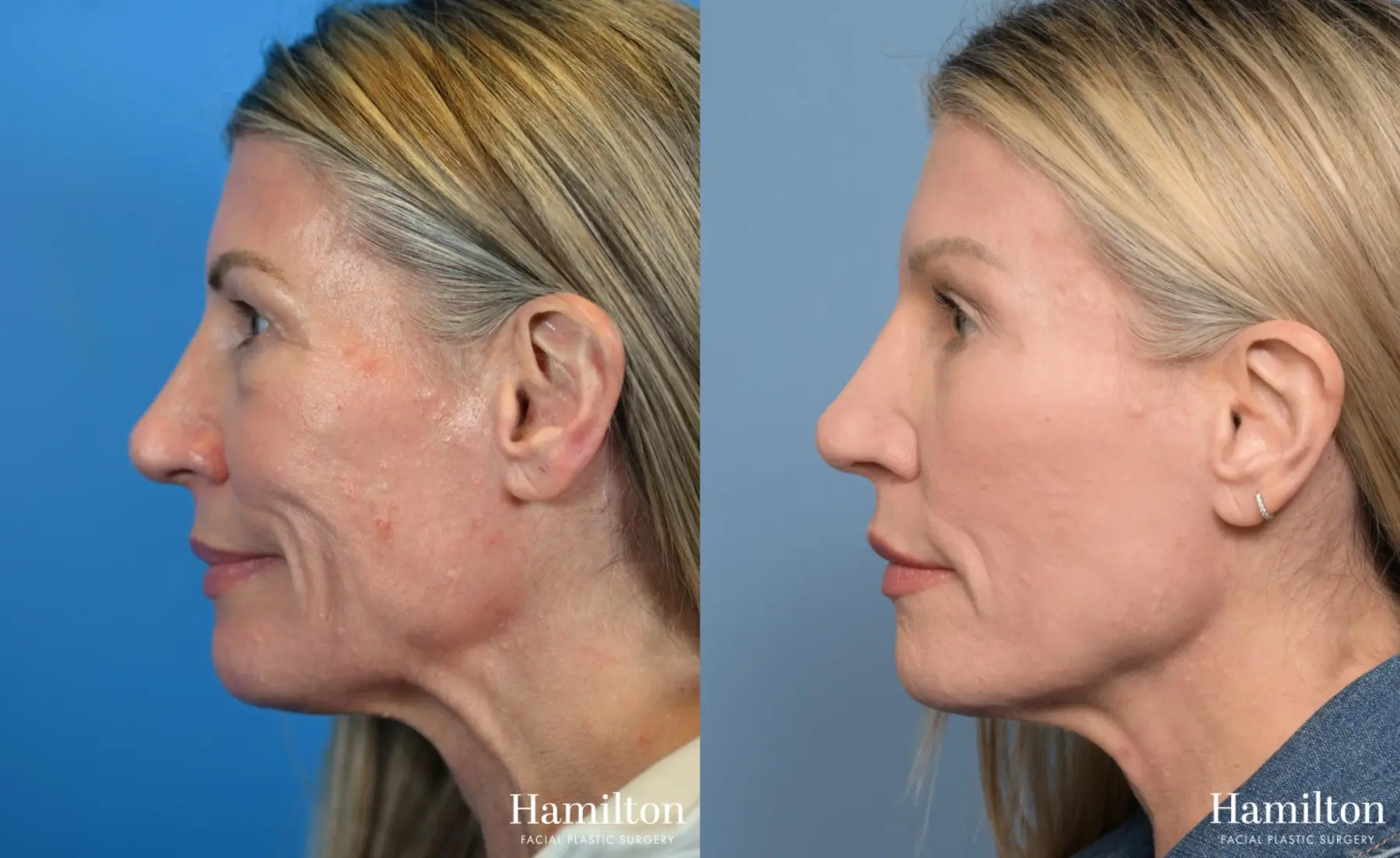 Brow Lift: Patient 6 - Before and After 2