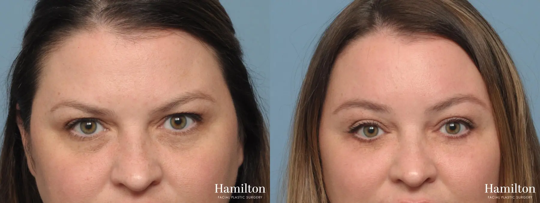 Brow Lift: Patient 1 - Before and After  