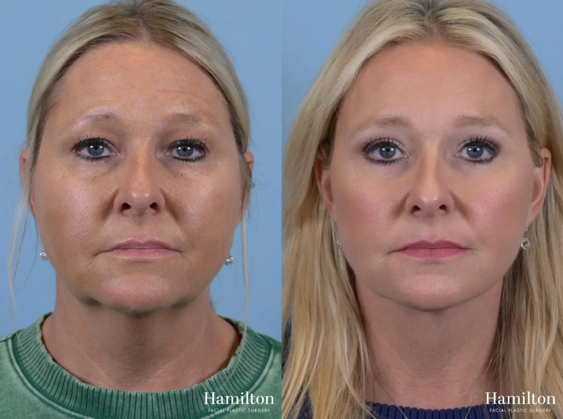 Brow Lift: Patient 6 - Before and After 4