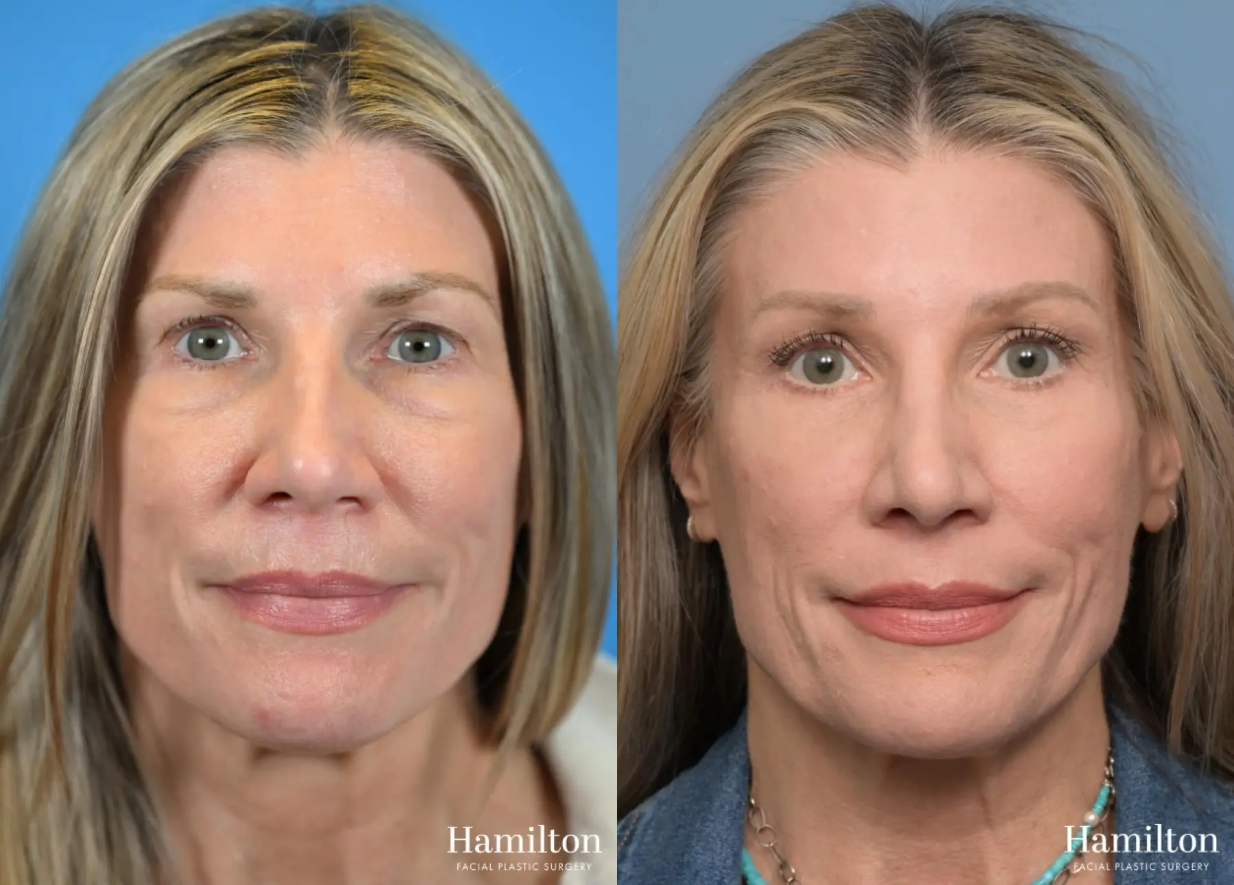 Brow Lift: Patient 6 - Before and After  