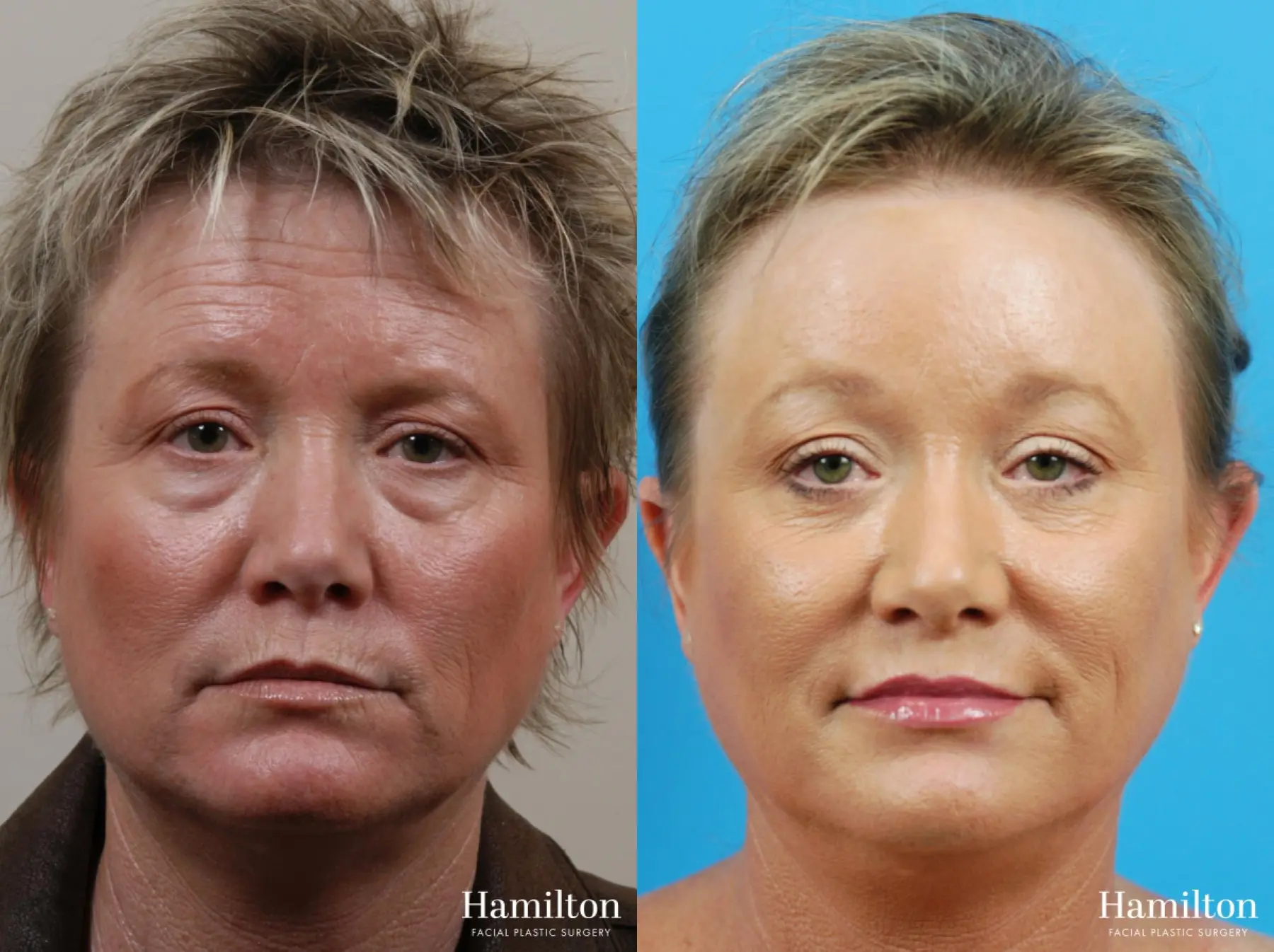 Brow Lift: Patient 7 - Before and After 1