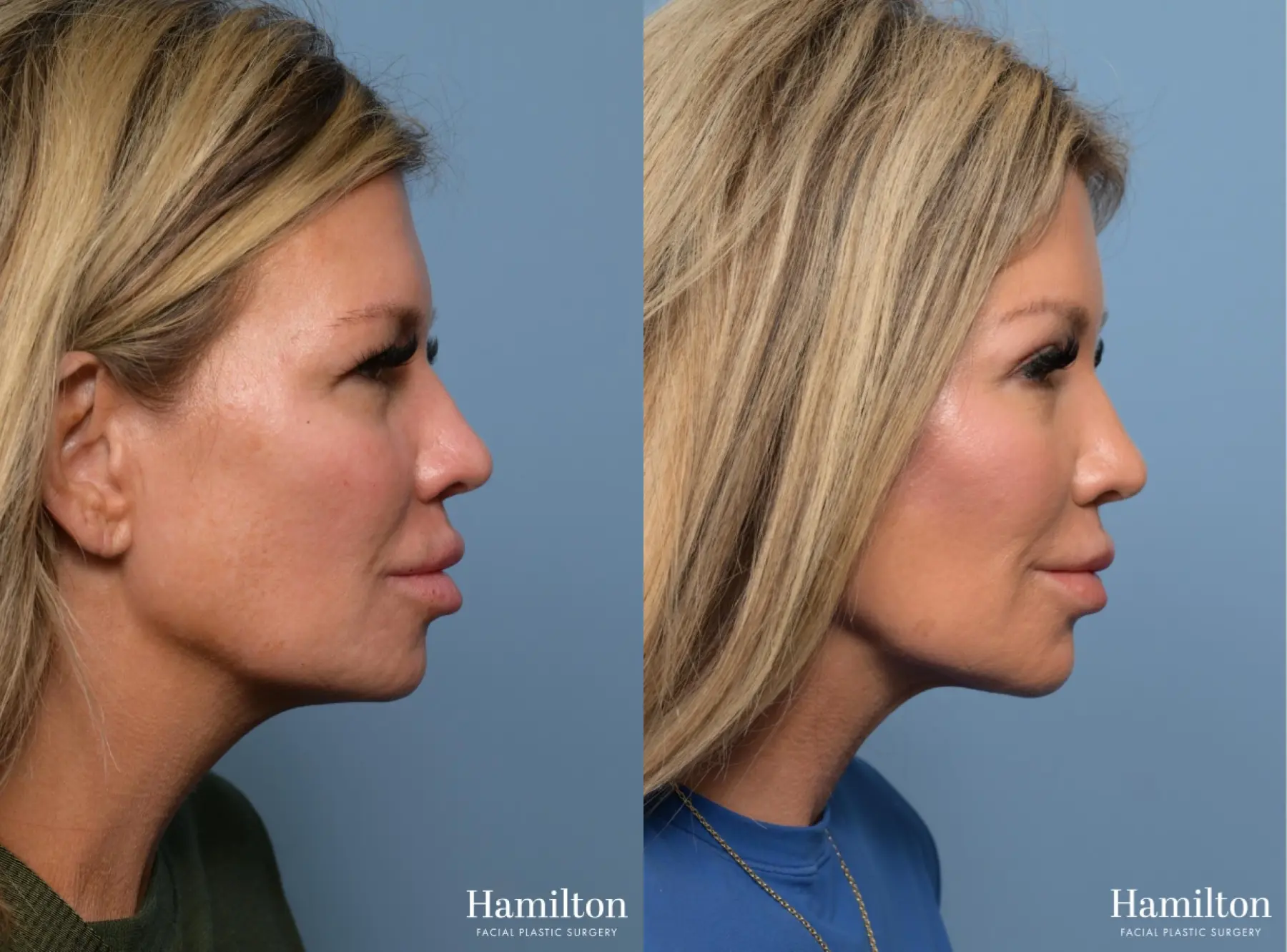 Brow Lift: Patient 2 - Before and After 4