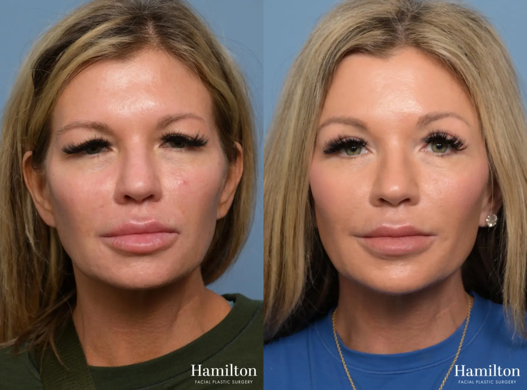 Brow Lift: Patient 2 - Before and After  