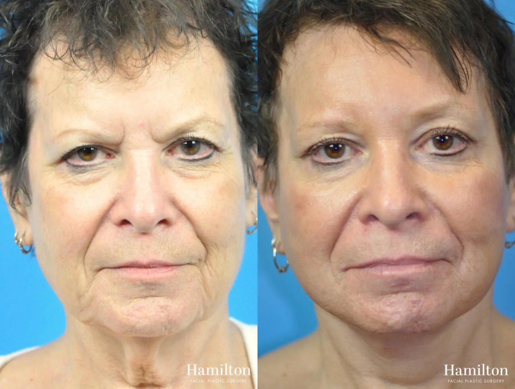 Brow Lift: Patient 11 - Before and After 1